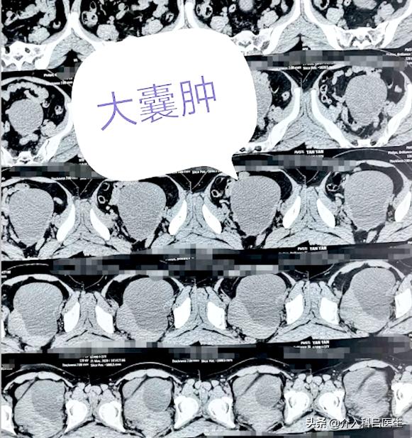 巧克力囊肿导致月经淋漓不尽,巧克力囊肿月经紊乱