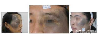 青胎记成因症状及危害科普,背中间靠左青胎记代表什么