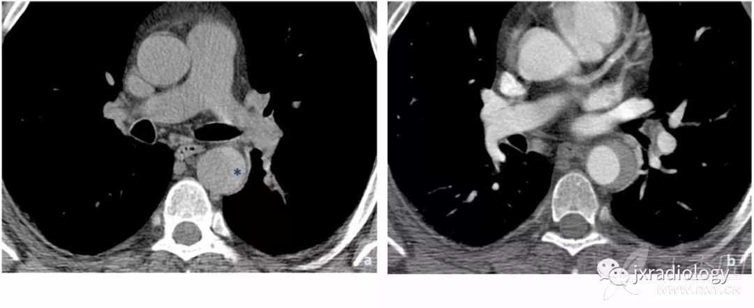 急性主动脉综合征报道,急性主动脉综合征症状