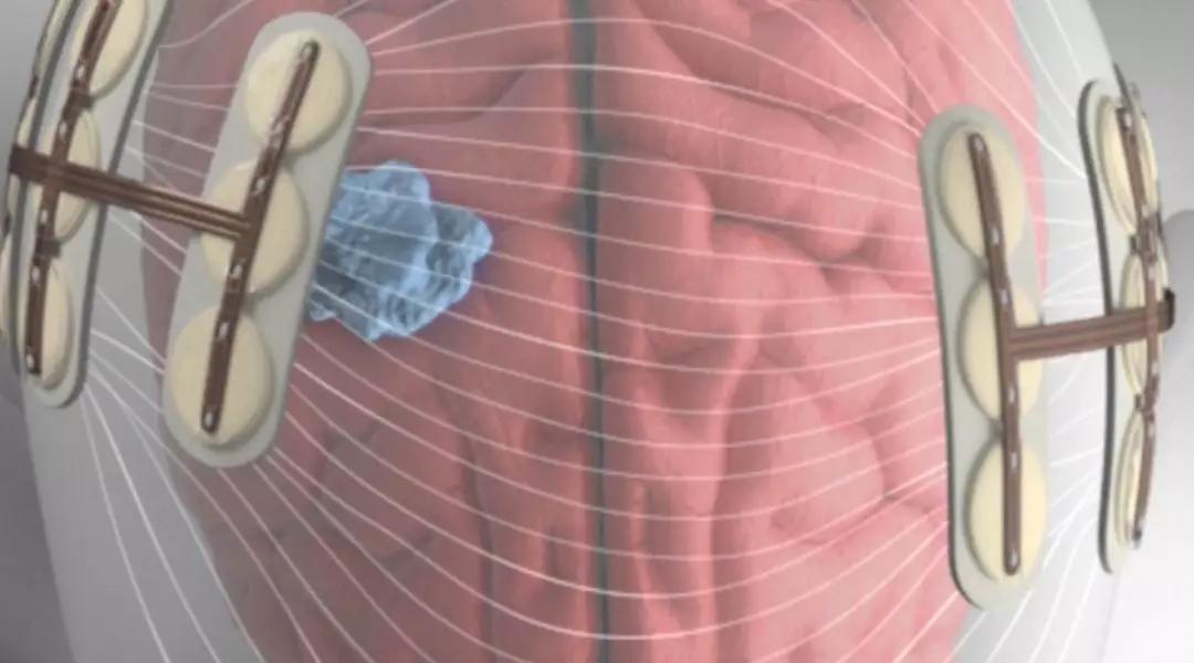 癌细胞电场疗法,内置电场杀死癌症细胞