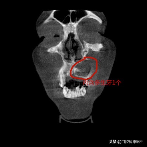 上颌左边埋伏阻生牙的拔除视频,埋伏阻生牙拔除会得干槽症吗