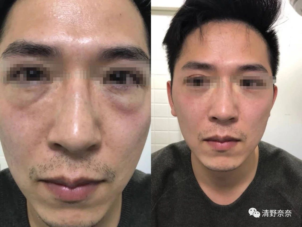 解决眼部干纹黑眼圈最好的方法,黑眼圈眼袋干纹怎么消除