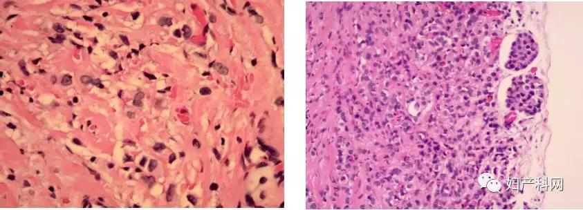 乳腺癌卵巢转移病例,乳腺癌病例分析ta2