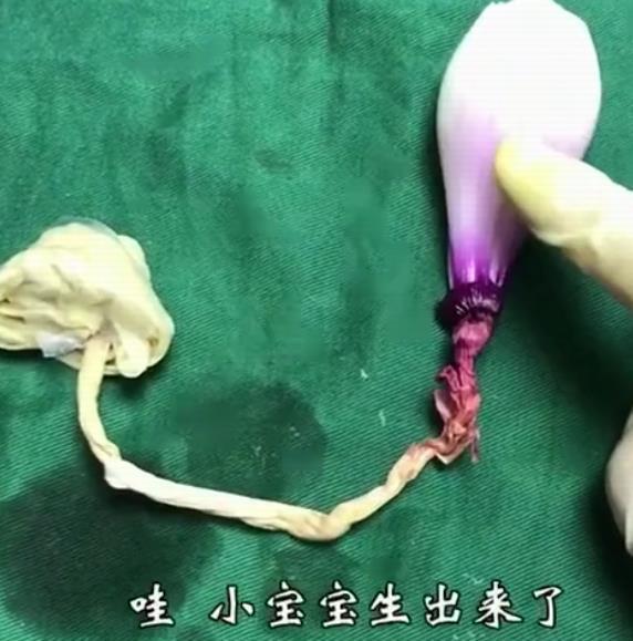 剖腹产的手术全部流程,洋葱模拟剖腹产手术