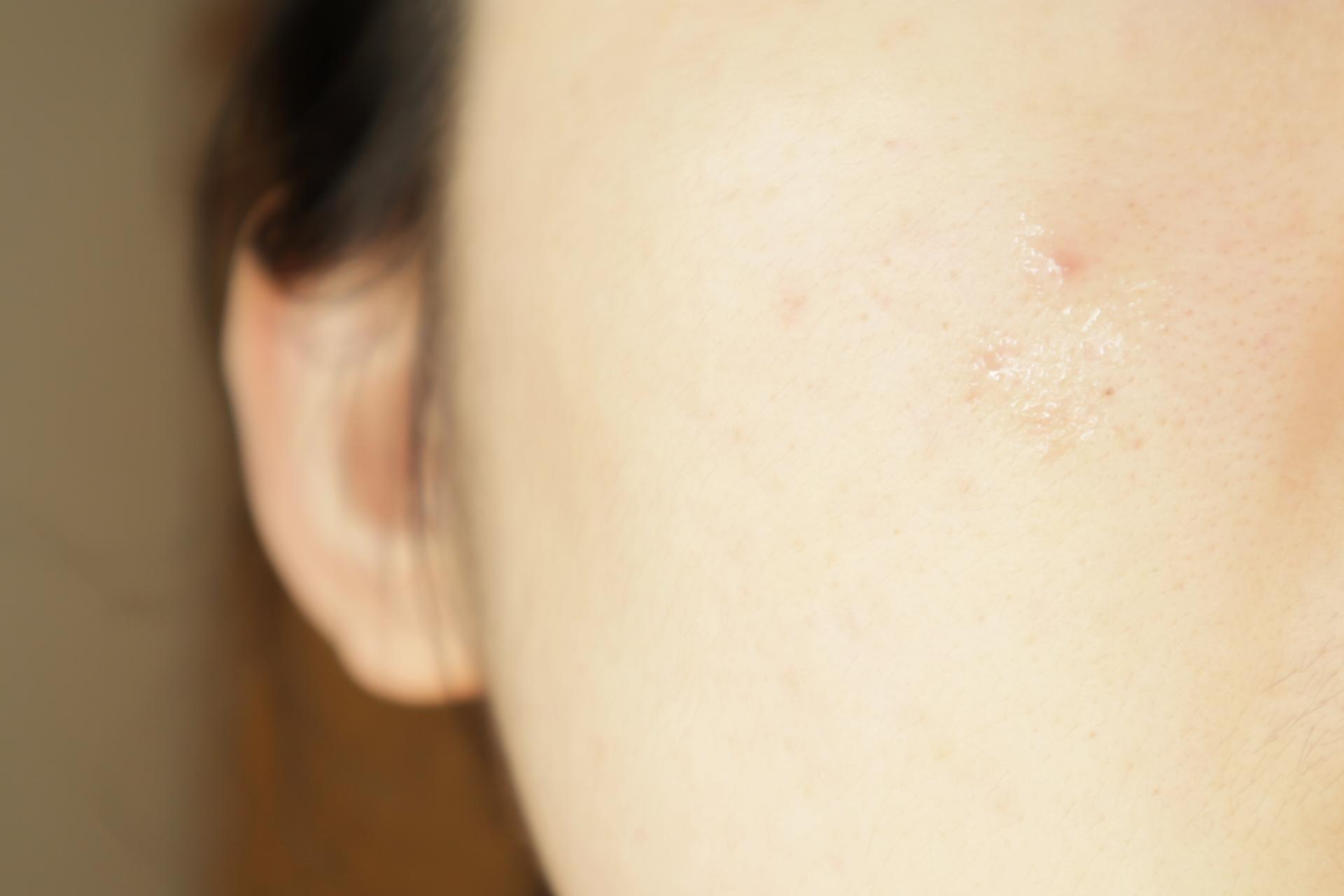 谁说野火烧不尽,战痘经验值万金