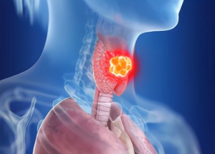 甲状腺囊肿2mm有什么症状和危害,甲状腺胶质潴留囊肿有哪些症状