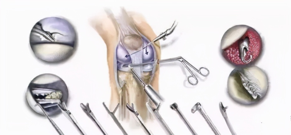 关节镜的适应症是什么,关节镜操作流程及注意事项