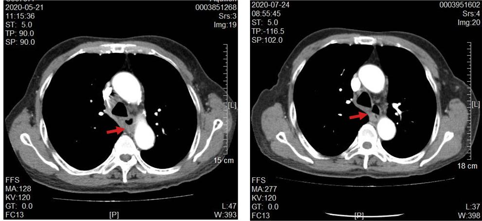 78岁肺癌晚期老人能用靶向药吗,食道癌通过化疗肿瘤消失成功案例