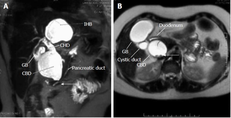 年轻女性反复肚子疼、黄疸、发热，仅仅是胆结石那么简单吗？