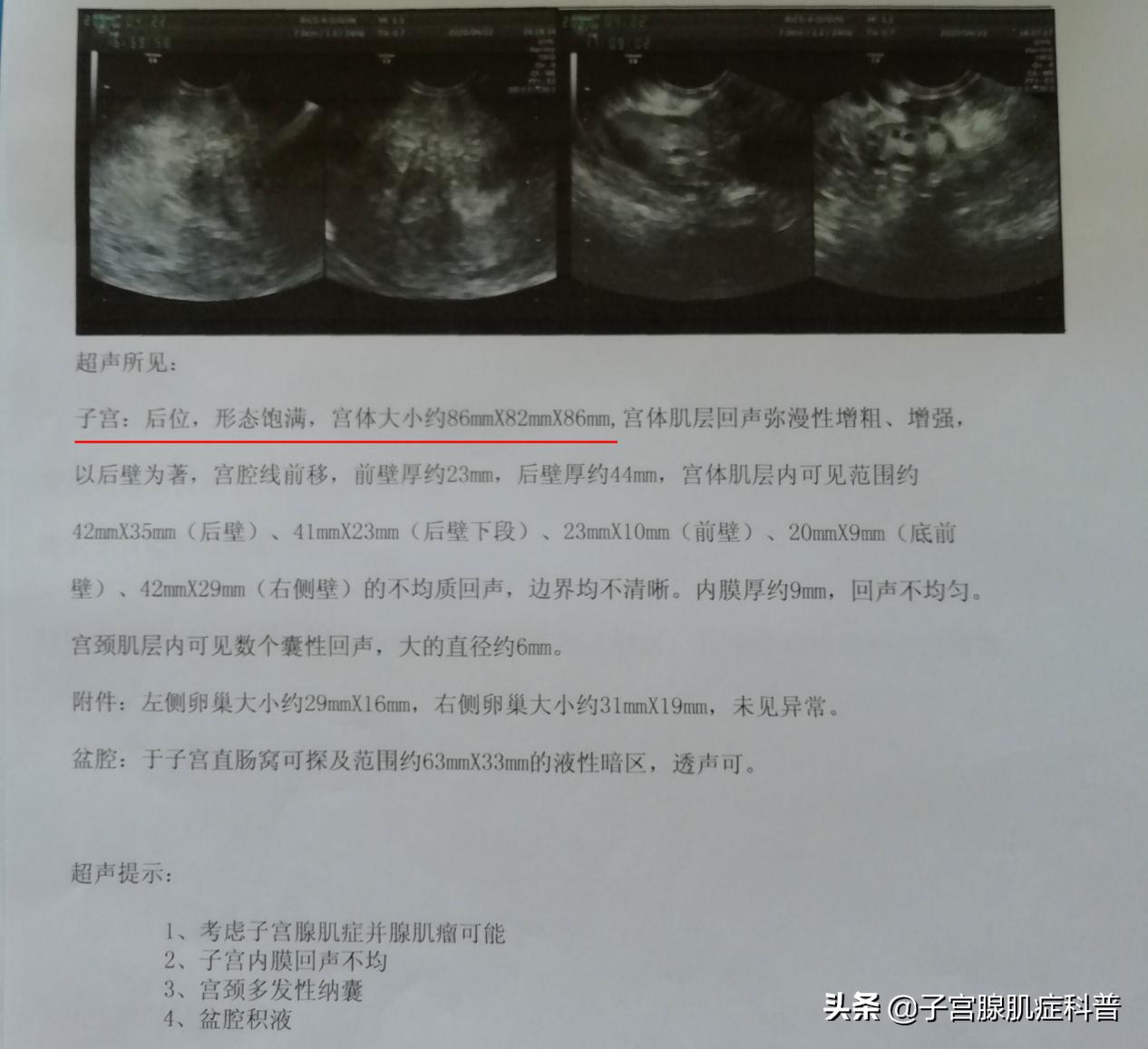 中医推拿真能缓解子宫腺肌症吗,子宫腺肌症推拿