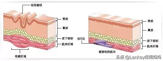 真性皱纹的定义假性皱纹的定义,一笑才有的皱纹是假性皱纹吗