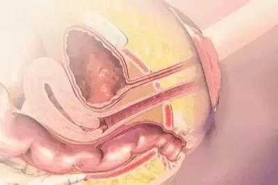 产后漏尿很烦很沮丧,产后漏尿是尴尬还是可怕