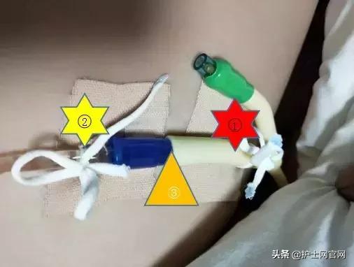 尿管固定别小看5cm,却是“血”的差距!