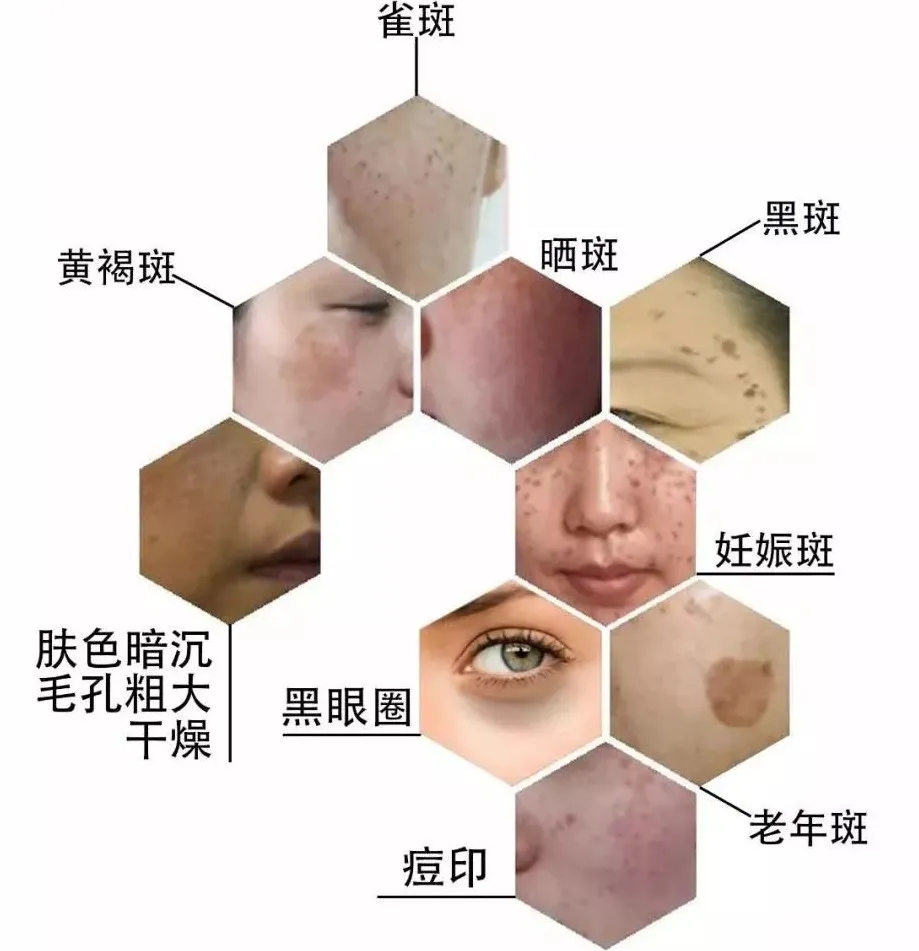 教你一招告别斑点,20年的斑点终于找到解决的办法了