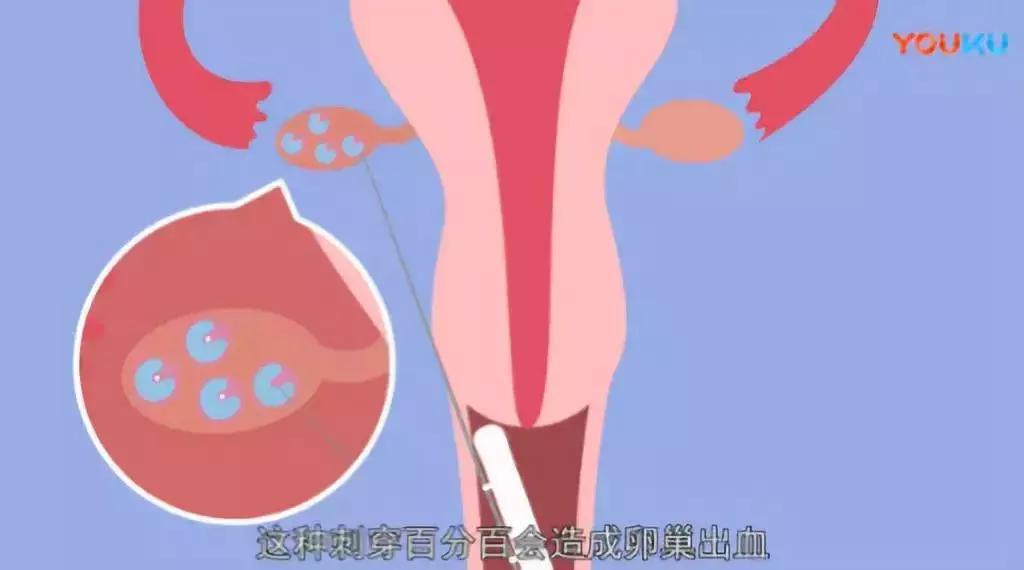 不打麻药取40颗卵子,不打麻药取29颗卵子有多疼