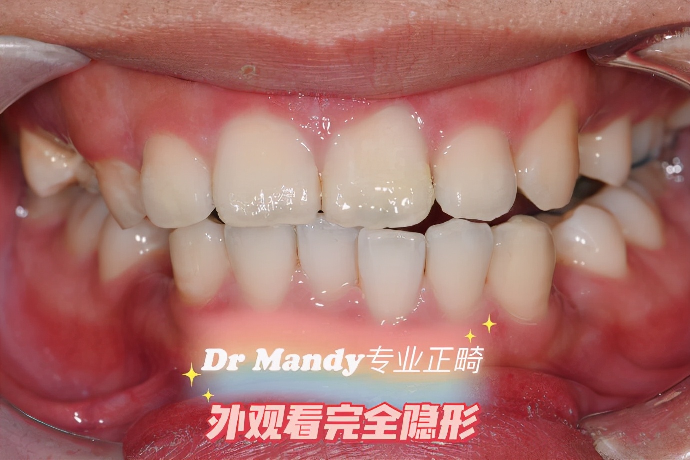 杭州如何选择牙齿矫正,杭州牙齿矫正哪个医生好