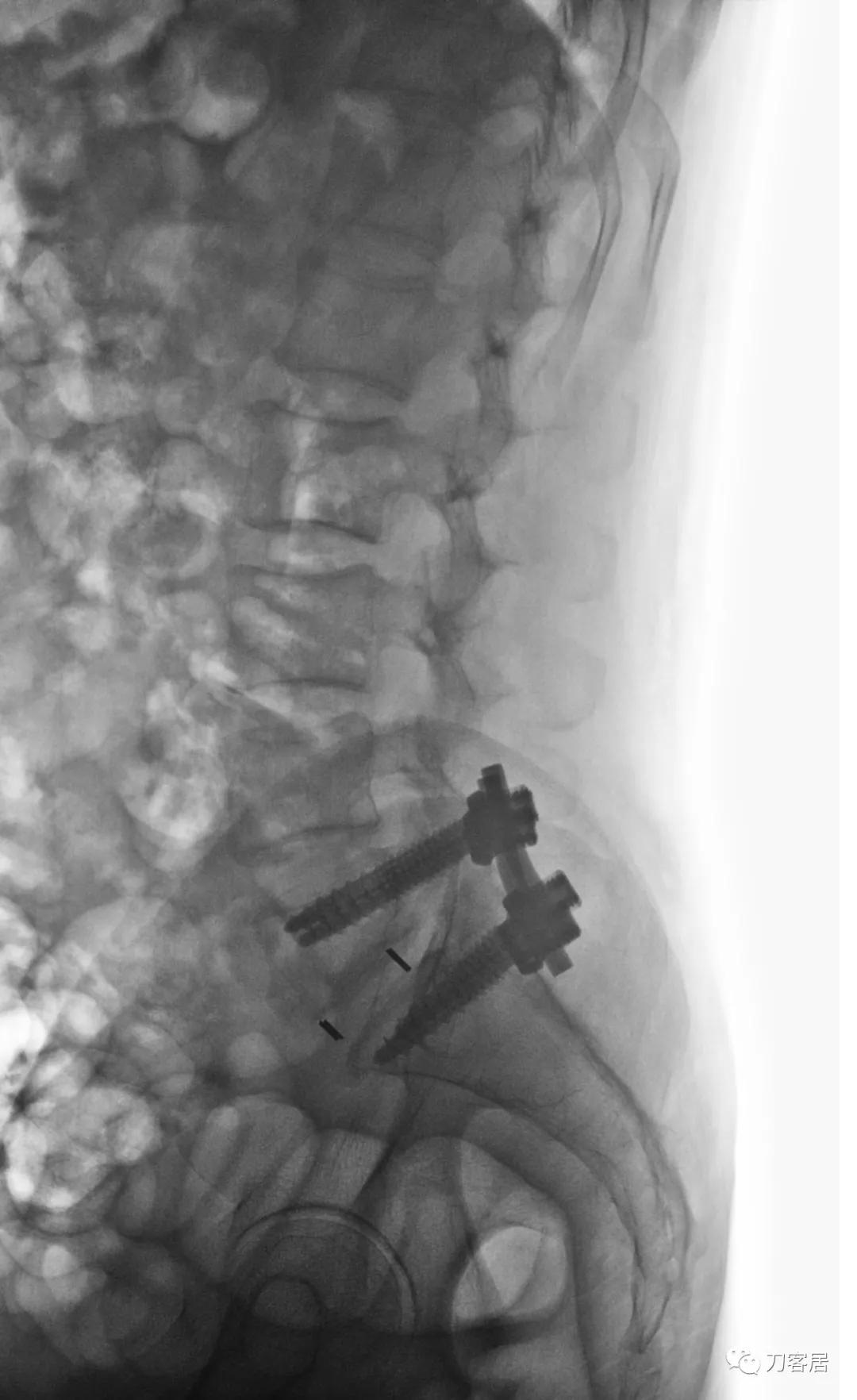 小针刀扎到坐骨神经会瘫痪吗,小针刀会切断坐骨神经吗