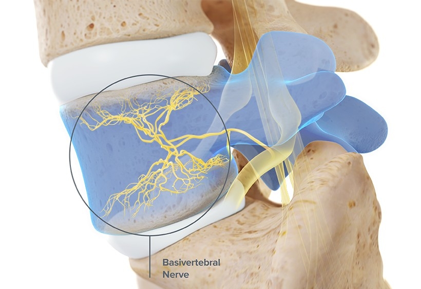 久治不愈腰痛,磁共振没有突出间盘后缘白点,要警惕这病③