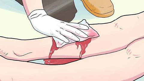 静脉大出血是怎么回事,肝硬化胃部静脉曲张导致大出血