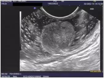 直肠神经内分泌肿瘤分级和治疗,直肠神经内分泌肿瘤到底是不是癌