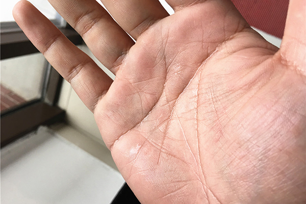 手上起小水泡很痒是湿疹还是过敏,水泡湿疹和汗疱疹区别