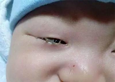 宝宝眼屎多并非都是上火惹的祸！这几种情况需要就医