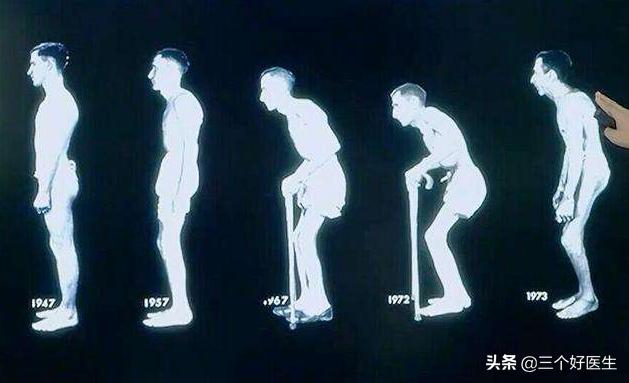 强直性脊椎炎的正骨治疗及预防