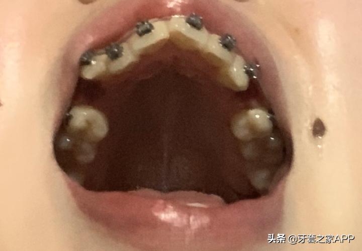 不靠整容怎么改变下巴后缩?看这里