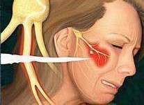 三叉神经痛需要抗癫痫治疗吗,癫痫引起的三叉神经痛怎么治疗