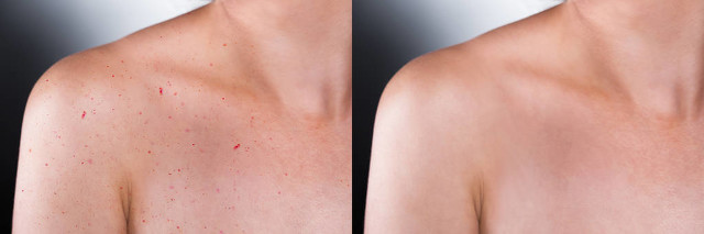 胸口痘痘变成硬疙瘩用什么药,胸口痘痘变成红色鼓包