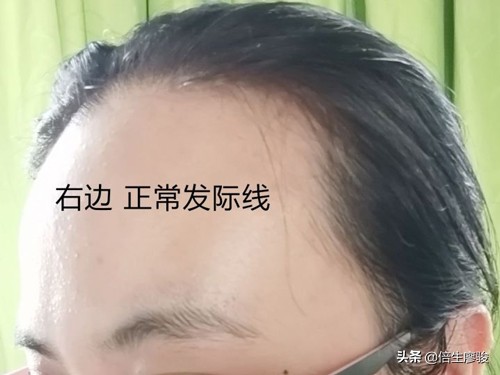 发际线突然秃了一块怎么扎马尾,女生发际线秃了吃什么