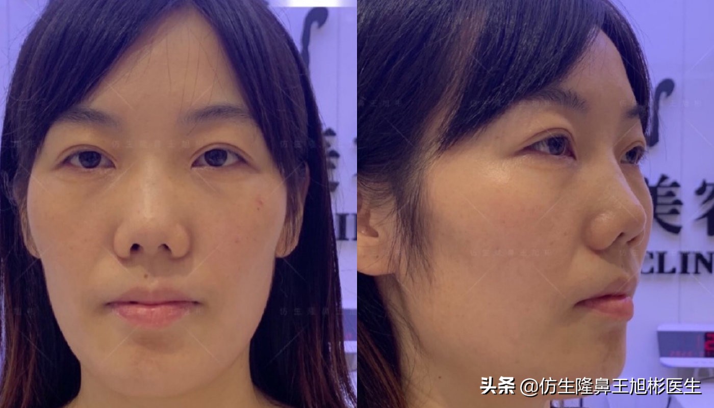 短鼻延长,短鼻塌鼻可以逆袭变长吗