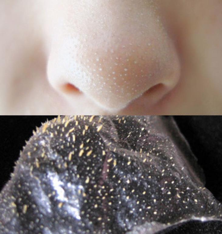 黑头用镊子直接从毛孔拔出来,黑头用镊子直接从毛孔拔出来好吗