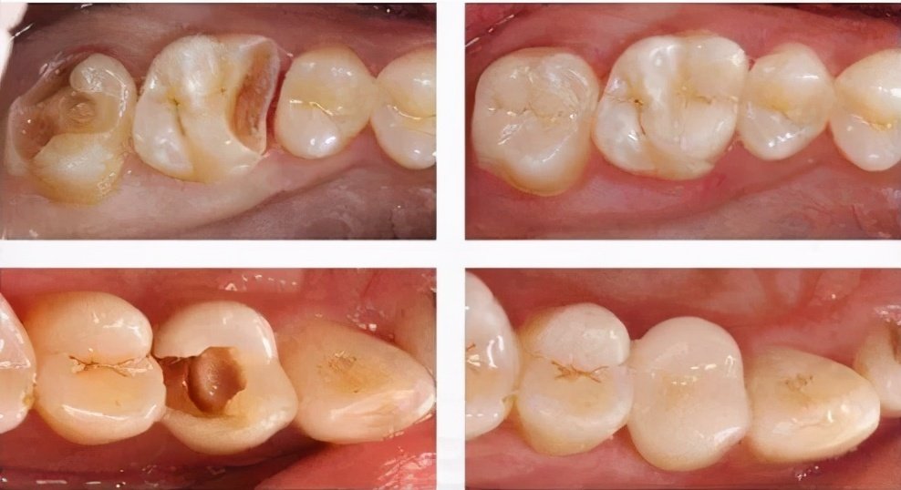 急性牙髓炎诊断错牙齿了怎么办,门牙牙髓坏死根尖炎怎么办