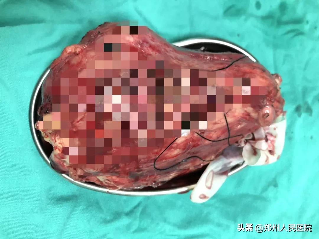 尿血需警惕吸烟也可能引起膀胱癌,尿血要警惕三种疾病