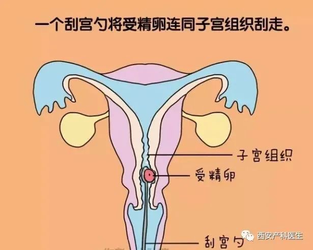 今天做人流明天就上班段子,今天做人流明天上班