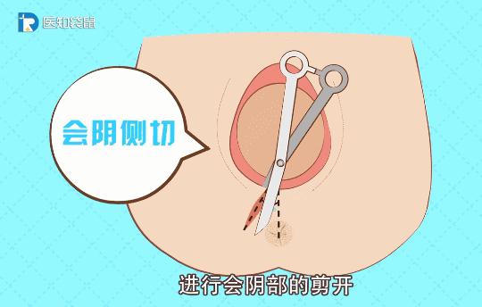 顺产要不要挨剪刀,顺产怎么才可以避免侧切