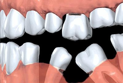 烂牙残根不拔的危害大吗,多的烂牙残根不拔的危害大吗