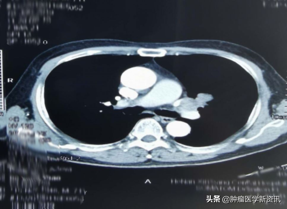 肺癌早期的6个信号中医治癌,肺癌正确的抗癌方法
