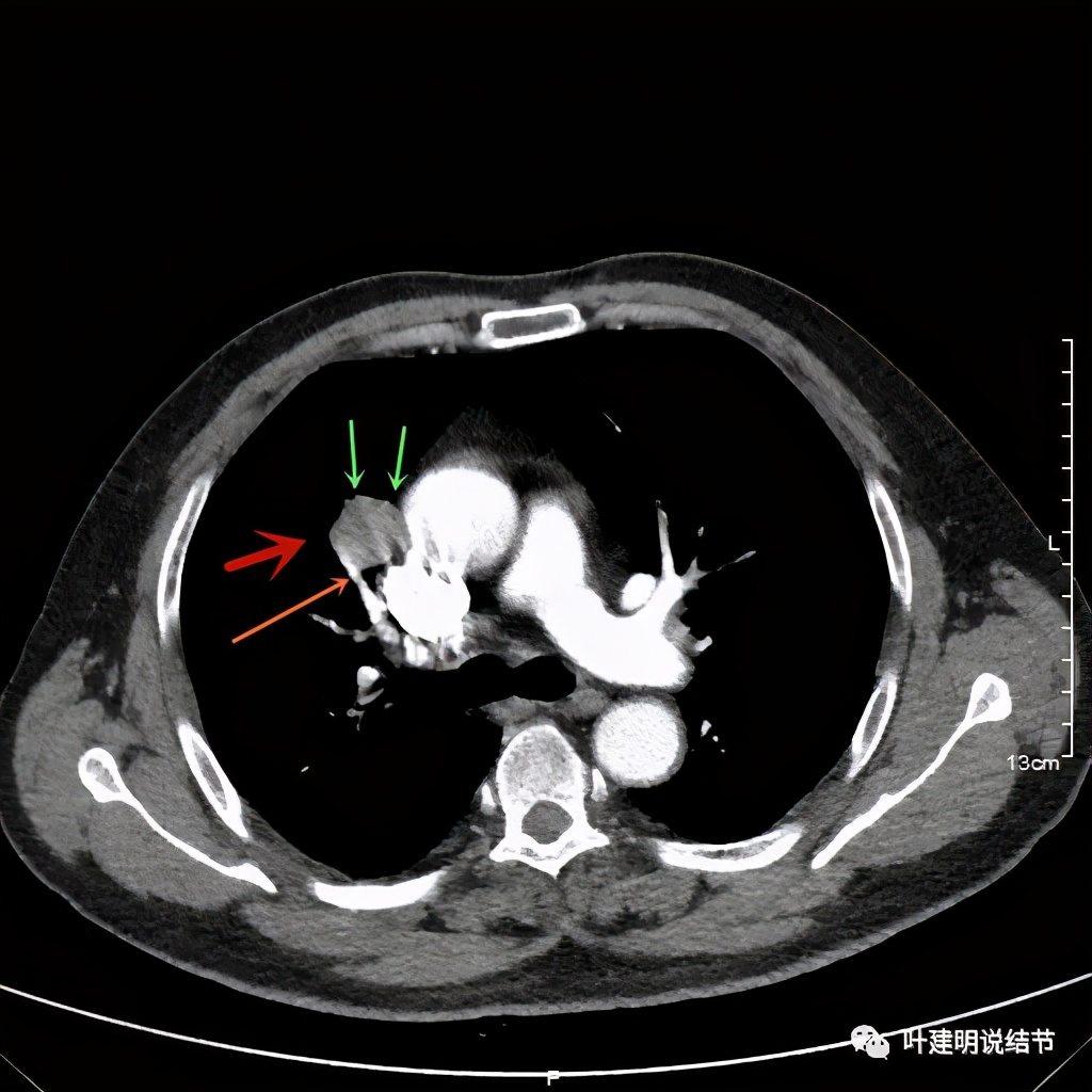 误诊报告图片,误诊案例及案例分析