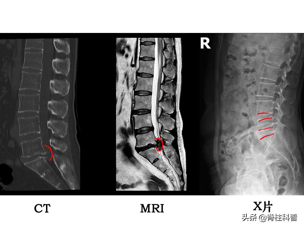 x光看不清楚ct显示骨折,x光看不出腰突吗
