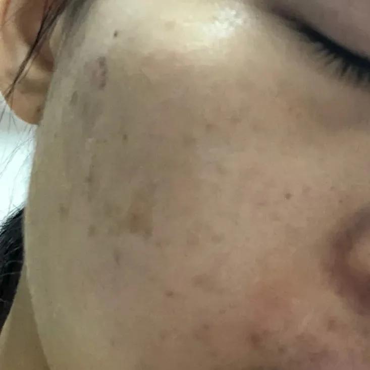 辟谣、吃酱油加深痘印？芦荟胶治好痘坑？别傻了！