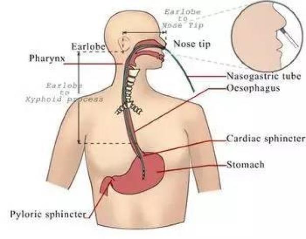 icu插胃管全过程,icu护士讲课视频