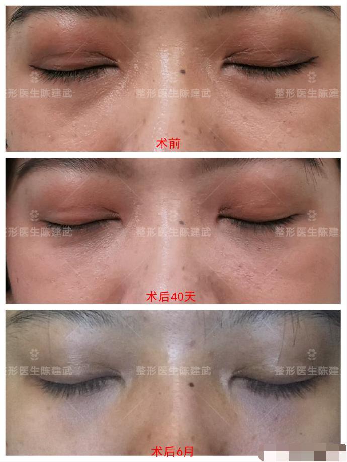 眼袋手术为什么不能侧睡,眼袋手术感觉眼睛闭不上