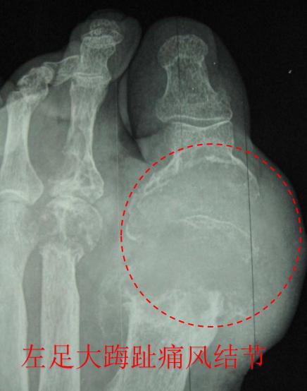 发作一次痛风诊断痛风性关节炎,痛风性关节炎和痛风哪个最严重