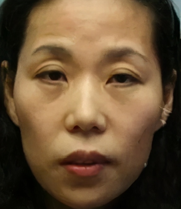 面部显老憔悴怎么办,显老显丧的面颊凹陷应该如何改善