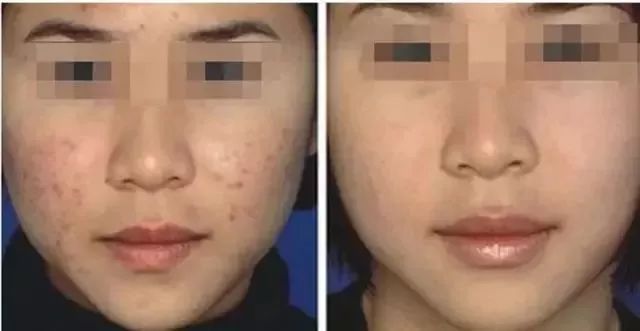 干粉冷冻,冷冻干粉的作用和功效