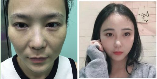 除皱小妙招,真性皱纹最快的除皱方法