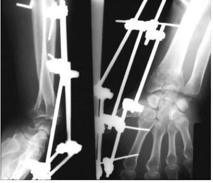 带你了解骨科术后康复,骨科早期康复介入
