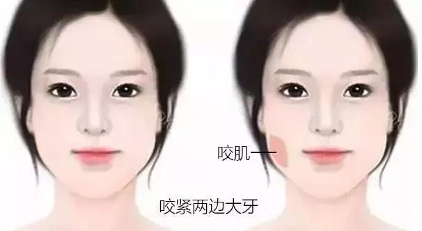郑州瘦脸针维持时间,瘦脸针后咬肌变化图